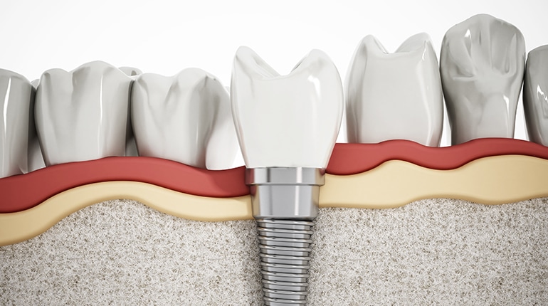Dentists implants visual