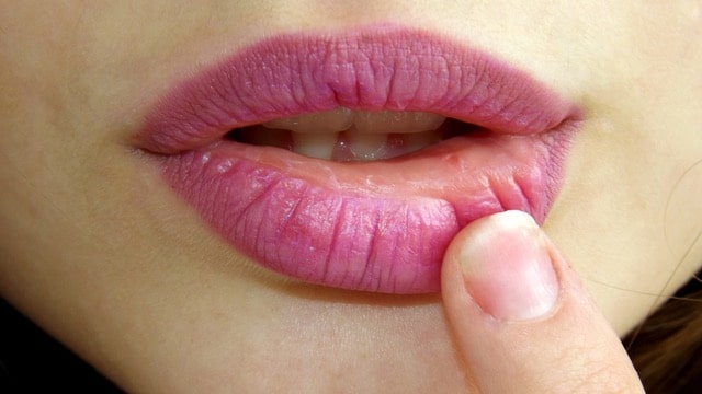 herpes lips