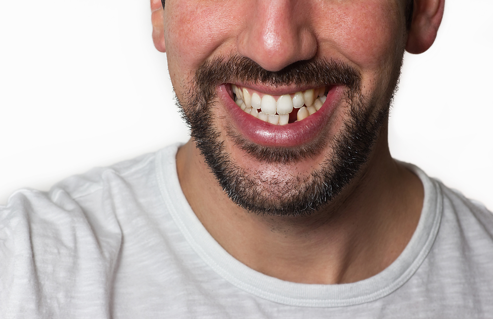 The Importance of Replacing Missing Teeth