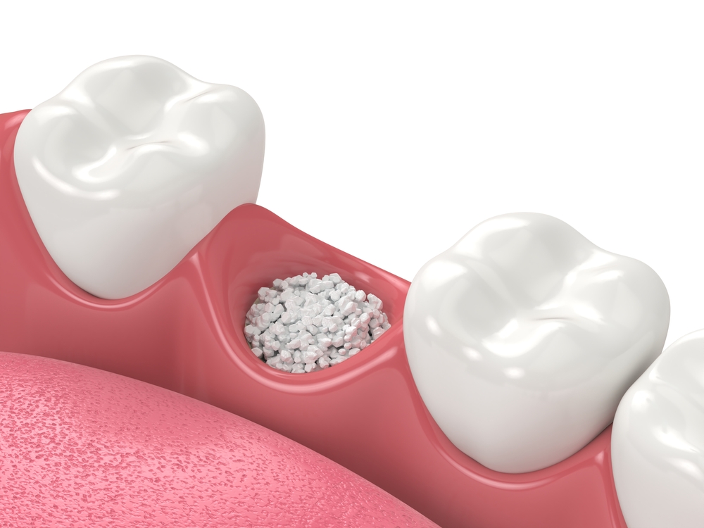 Dental Implants and Bone Grafting